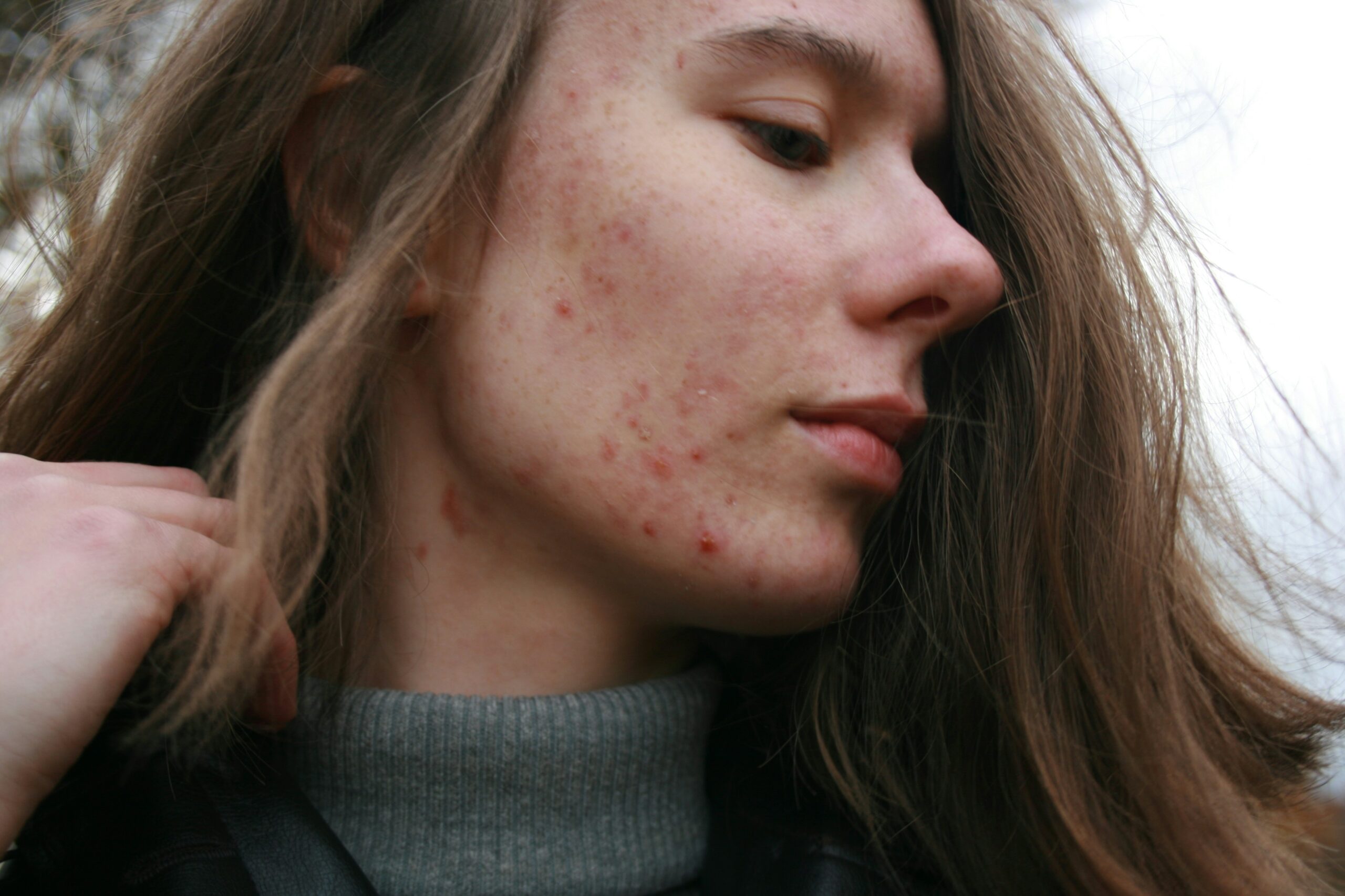 acné hormonale